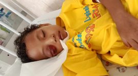 Shasfa Rijal, Balita Asal Desa Bobanehena Kecamatan Jailolo, Kabupaten Halmahera Barat yang didera kanker mata 